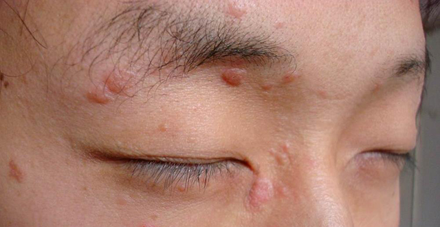 寻常疣激光后会复发吗,治疗寻常疣的方法