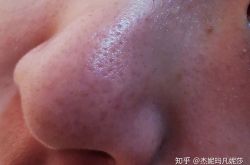鼻子上的黑头怎么去掉，如何清理?