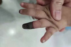 間違った包帯で3歳の女の子が指を切った！多くの親がこの低レベルの間違いを犯しました！