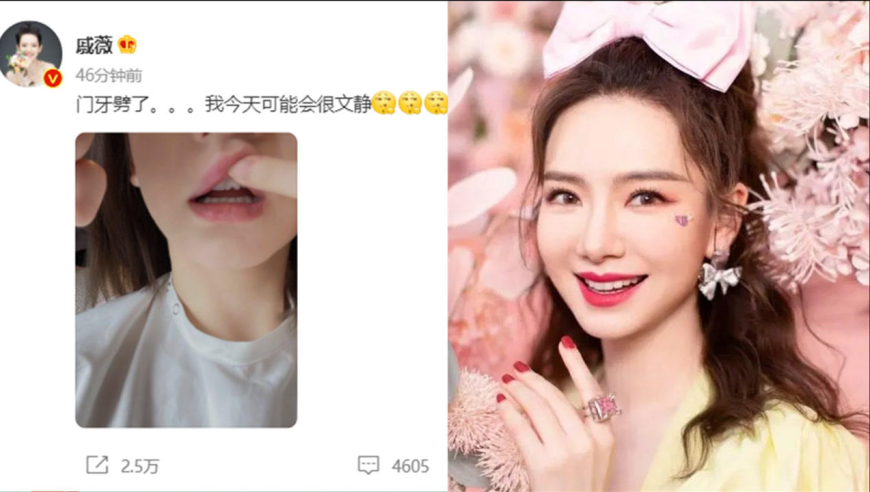 36岁戚薇牙齿受伤照曝光!大门牙直接缺一块,还要被自己老公"嘲笑"