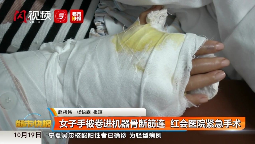 女子手被卷进机器骨断筋连 红会医院紧急手术