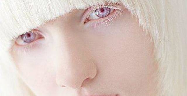眼白化病会引起眼一系列严重的功能改变,患者大多缺乏黑色素