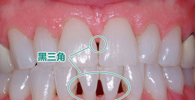 整牙出现"黑三角"?正畸背过的"锅"可真不少