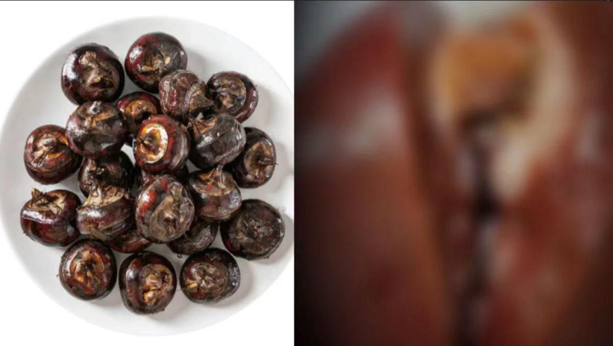 27岁女子生吃荸荠体内取出2条姜片虫,喜欢吃这些食物要注意了