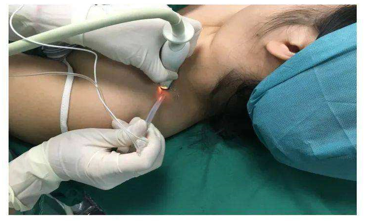 是一种当时我们麻醉医生认为很好的一种麻醉——颈丛神经阻滞