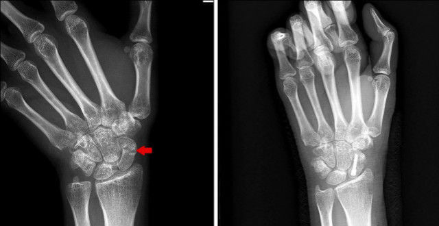 手腕疼痛wrist pain-佛山康复