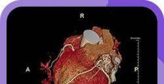 Atorvastatin and Rosuvastatin are the strongest in reducing lipids? This article makes it clear