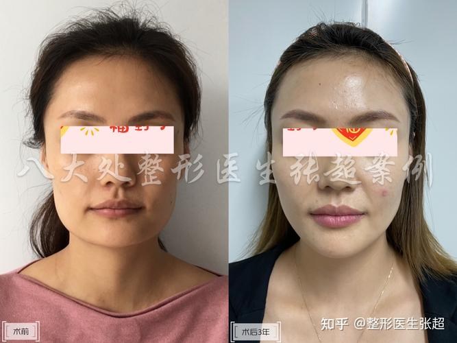 正頜手術哪家醫院好？做正頜手術怎么選擇醫院？