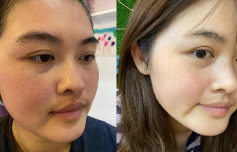 黃褐斑怎么去除效果好？如何快速祛除黃褐斑？