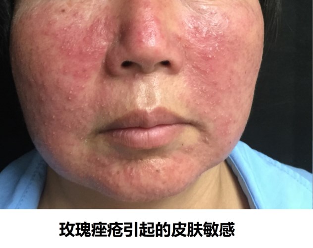 臉皮薄容易臉紅怎么辦？臉皮薄是怎樣的體驗？
