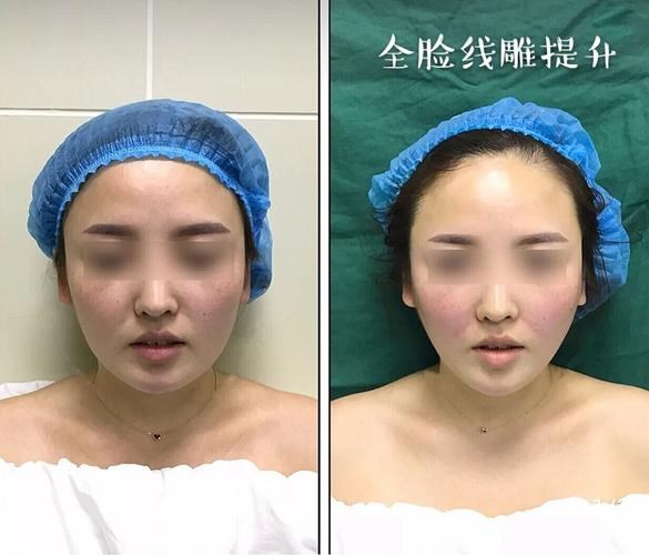 臉上有皺紋怎么能去掉？臉上有皺紋怎么去除？