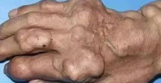 痛风反复发作,"大疙瘩"该如何消除?医生提醒:做好这3件事