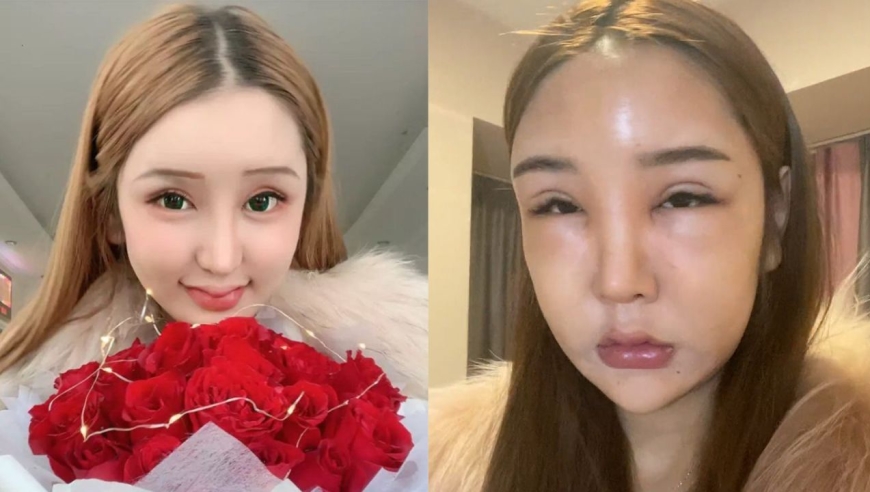 女网红整容上瘾,花费百万整容失败,如今毁容严重连亲妈都认不出