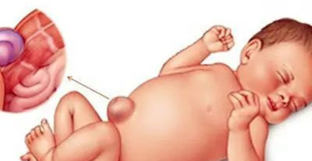 婴儿右下腹部鼓包图片图片