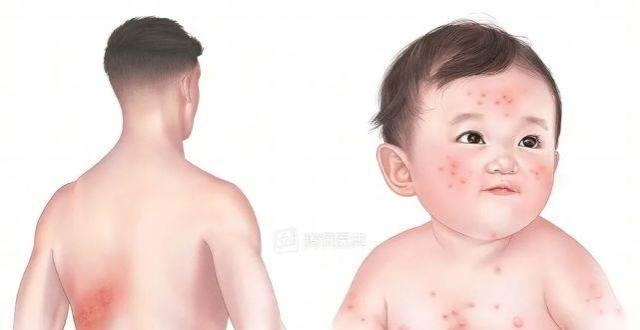 猴痘、牛痘、天花和水痘有啥区别？_腾讯新闻