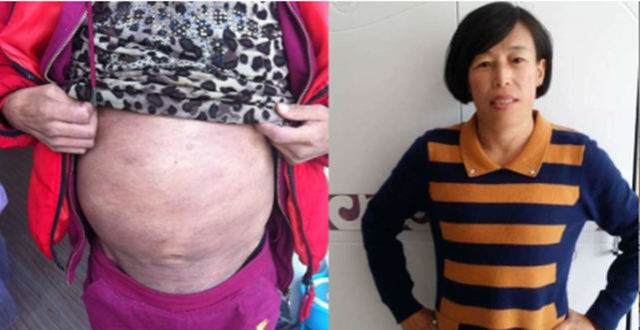 乙肝到肝癌,仅需这两步!