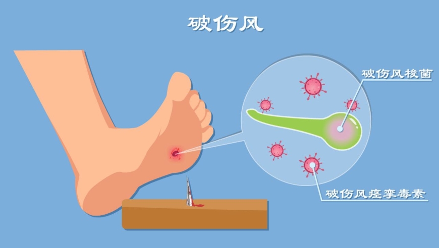 发作必死的破伤风,究竟啥样?