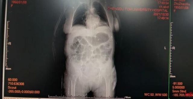 生吞3个鱼胆“清热”，72岁婆婆命悬一线_腾讯新闻