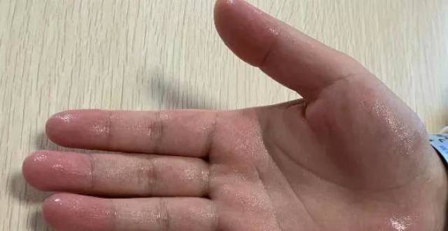手心出汗小常识最新文章