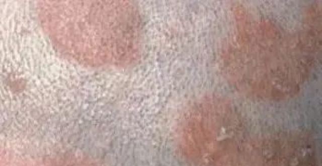 这三种皮炎常发却不好痊愈，一文教你如何处理_腾讯新闻