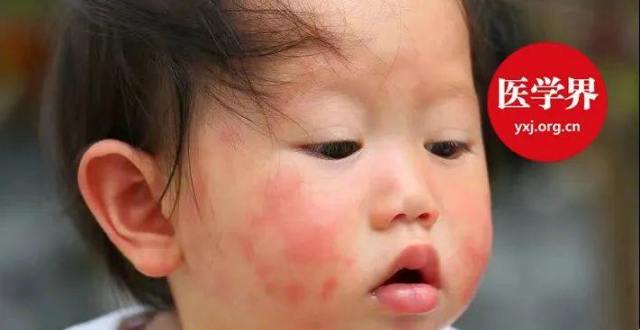 颠覆认知，原来“过敏”是这样进展的……_腾讯新闻