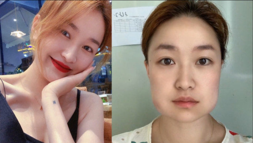 女子一口气拔掉四颗智齿,看到前后对比图网友惊呆了:这画面太有喜感了