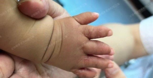 宝宝是并指短指，两只手差异比较大，还能恢复吗？_腾讯新闻