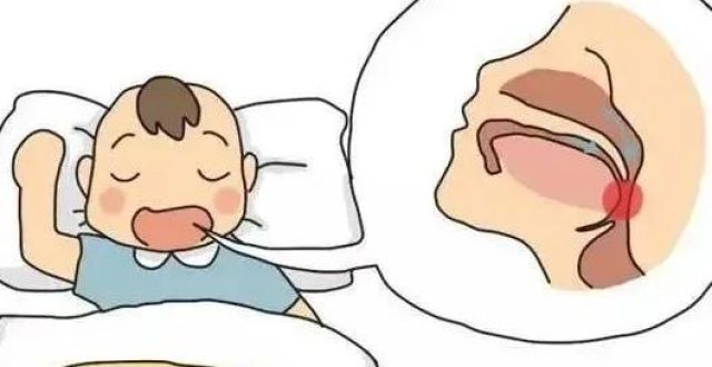 孩子张口呼吸、睡觉打鼾？当心是腺样体肥大！_腾讯新闻