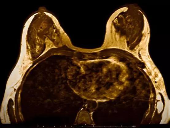 乳腺癌,乳腺,肿瘤