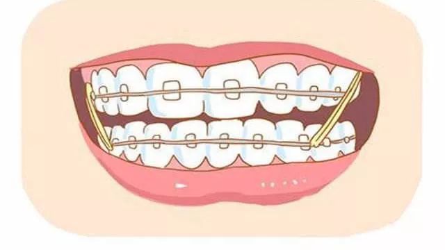 牙齒矯正橡皮筋的作用?