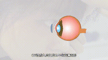 优点:满足孩子和家长,白天不用外戴框架眼镜,晚上佩戴角膜塑形镜,夜间