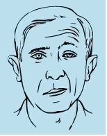 面肌痉挛(hemifacial spasm,hfs)又称面肌抽搐,通常由一侧眼睑阵发性