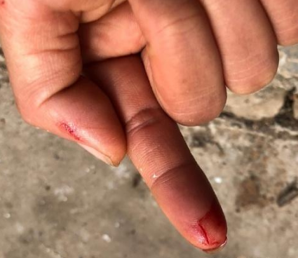 李子柒直播做饭砸伤手指,看清这个细节,外国网友都表示心疼她!