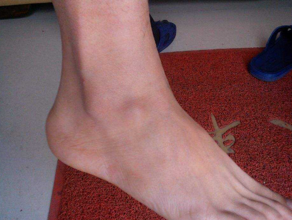 "尿毒症"多是拖出来的,身体会有"3处痛"都很明显,别忽视了