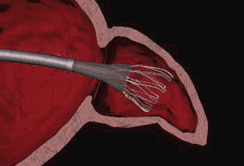 四川省科学城医院成功完成首例房颤患者射频消融 左心耳封堵"一站式"