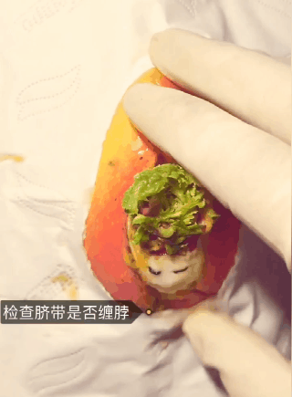 是锡纸烫的小婴儿清理干净呼吸道帮婴儿检查是否有脐带缠绕侧切结束后