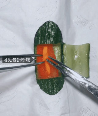 已经从肉疼升级为骨头疼了"拧完螺丝"后再检查一下骨折对线和钢板是否