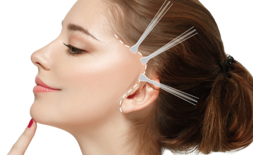 拉皮术,拉皮手术,面部拉皮,拉皮除皱,拉皮恢复自然