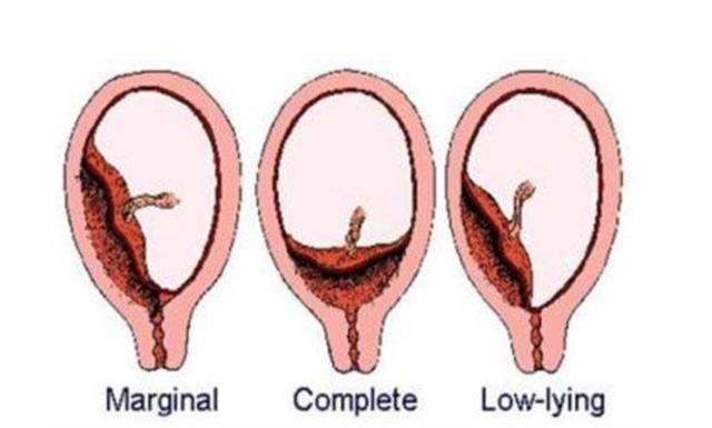 前置胎盤一般會按附著的具體位置差異又分為完全性,部分性和邊緣性