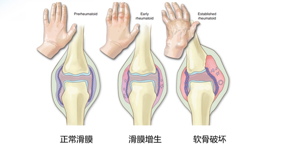 达标治疗——类风湿关节炎治疗的核心理念