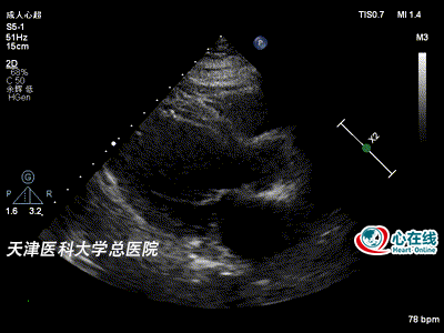 从一则"非典型"病例看超声心动图在冠心病诊疗中的价值_腾讯新闻