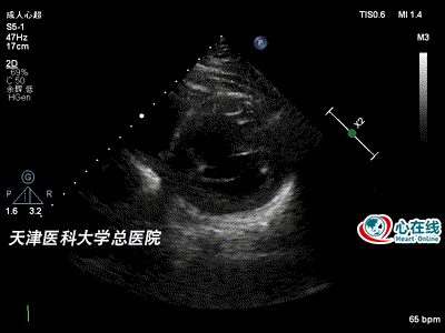 从一则非典型病例看超声心动图在冠心病诊疗中的价值