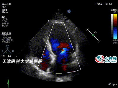 从一则"非典型"病例看超声心动图在冠心病诊疗中的价值_腾讯新闻