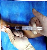 picc冲管不当导致堵管,正确冲封管,你真的会了吗?