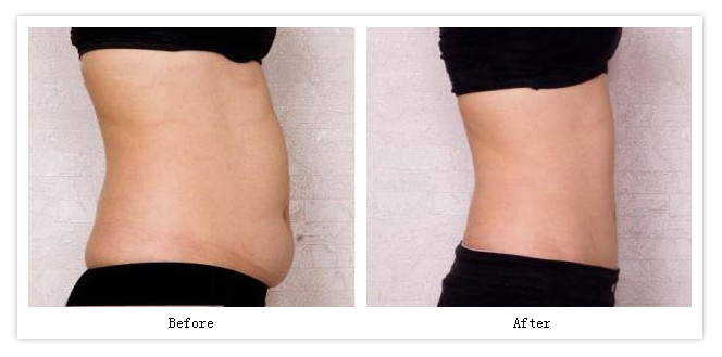 医生,我腰腹吸脂和大腿吸脂想一起做可以吗?-看点快报