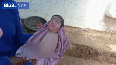 印度现 海豹娃娃 女婴出生就没有四肢 医生称实属 罕见 腾讯网