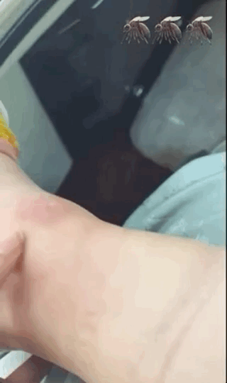 乔欣|乔欣象山拍戏被毒蚊子攻击，脚踝肿胀离谱，一按一个坑太夸张