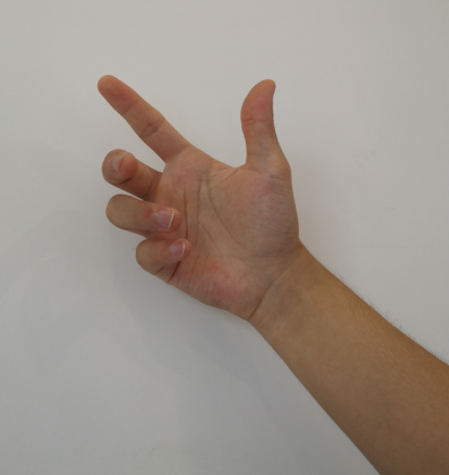 周围神经损伤,康复治疗手段多!