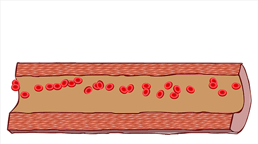 糖尿病并发症|这些油不能吃了，最新发现，它和糖尿病有关系