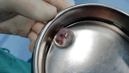 小心可能是会"要命"的宫外孕!